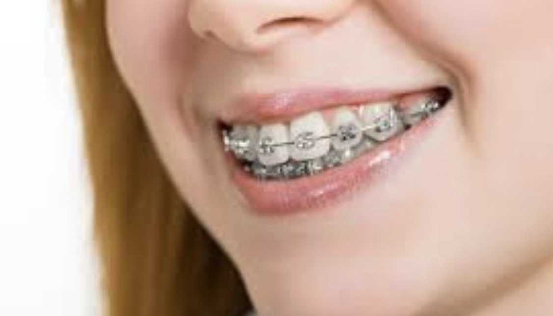 Family Orthodontic Care Guide Key Signs Your Teen Needs Early Smile Support