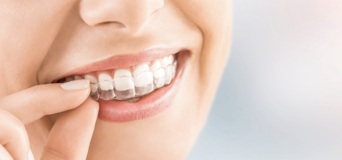 Perfect Fit Secrets for Clear Aligner Success and Faster Smile Results